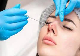 تجميل الأنف بالخيوطخطوات آمنة للحصول على أنف مثالي