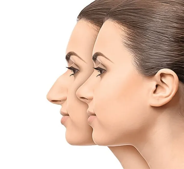 عمليات تصغير الأنف تحويل ملامحك بإتقان