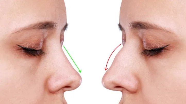أهم فوائد عملية تجميل الأنف ولماذا يقبل عليها الكثيرون