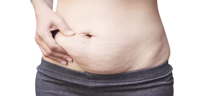 عملية تجميل البطن بعد الولادة